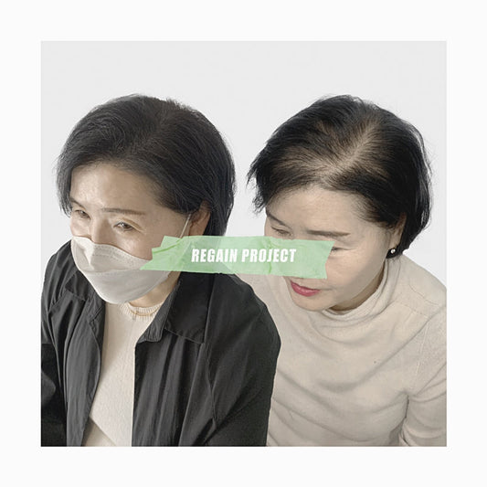 대구탈모관리 받고 자신감을 되찾은 후기